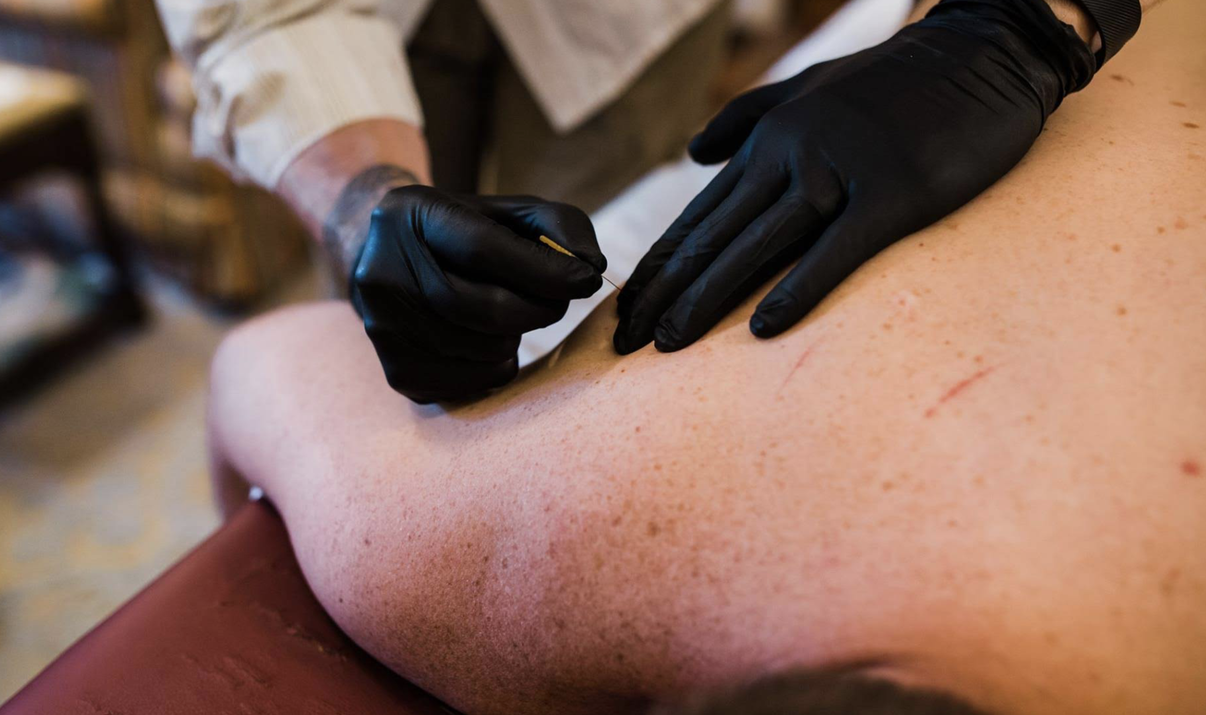 901 PT dry needling